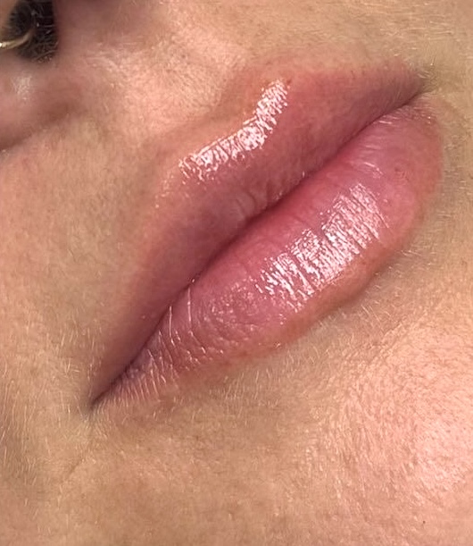 Después del tratamiento de labios