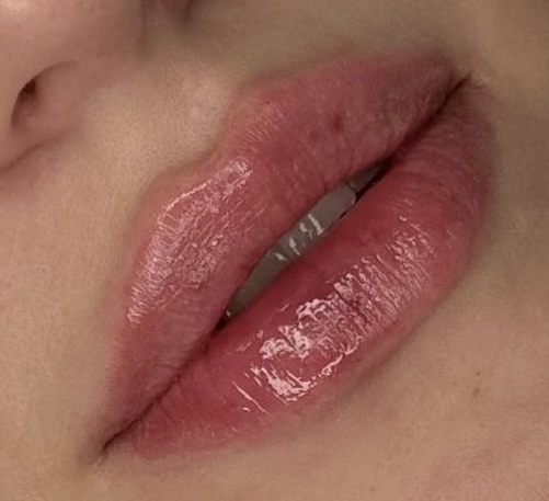 Después de bioestimuladores de colágeno