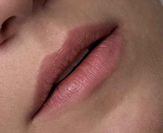 Antes de bioestimuladores de colágeno